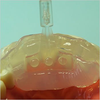 Fast Splint Matrix Positioning Tips - Synca